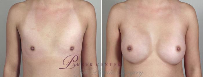 Breast Augmentation Case 396 Before & After View #1 | Paramus, NJ | Parker Center for Plastic Surgery