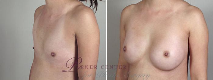 Breast Augmentation Case 396 Before & After View #2 | Paramus, NJ | Parker Center for Plastic Surgery
