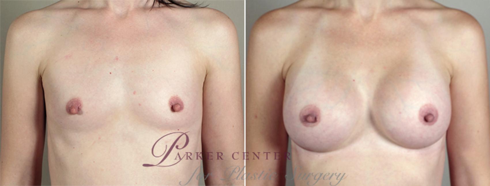Breast Augmentation Case 397 Before & After View #1 | Paramus, NJ | Parker Center for Plastic Surgery