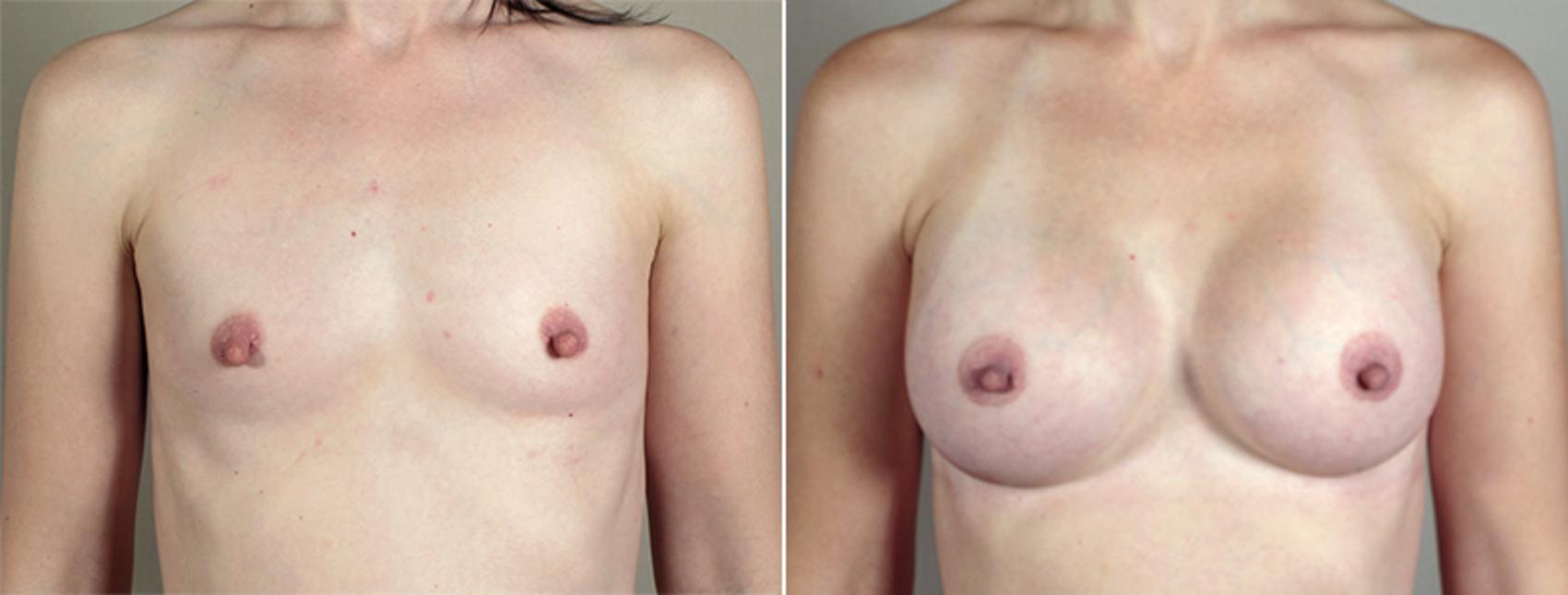 Breast Augmentation Case 397 Before & After View #1 | Paramus, New Jersey | Parker Center for Plastic Surgery