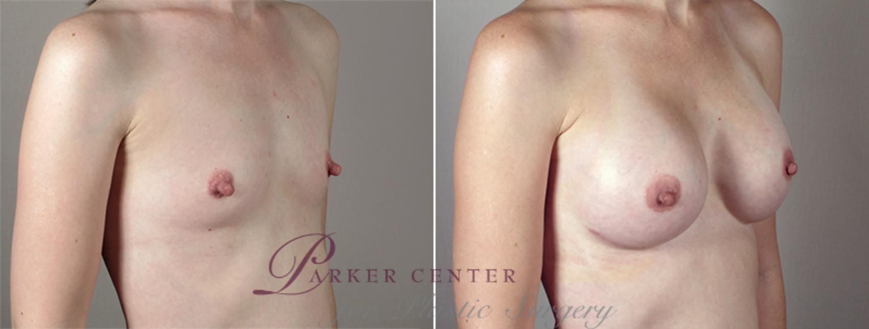 Breast Augmentation Case 397 Before & After View #2 | Paramus, NJ | Parker Center for Plastic Surgery