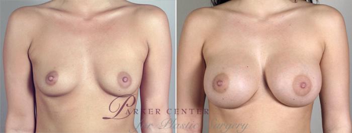 Breast Augmentation Case 398 Before & After View #1 | Paramus, NJ | Parker Center for Plastic Surgery