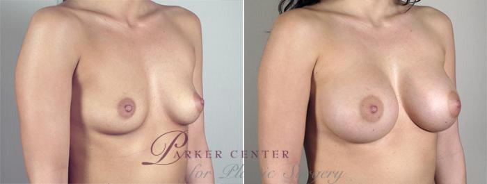 Breast Augmentation Case 398 Before & After View #2 | Paramus, NJ | Parker Center for Plastic Surgery