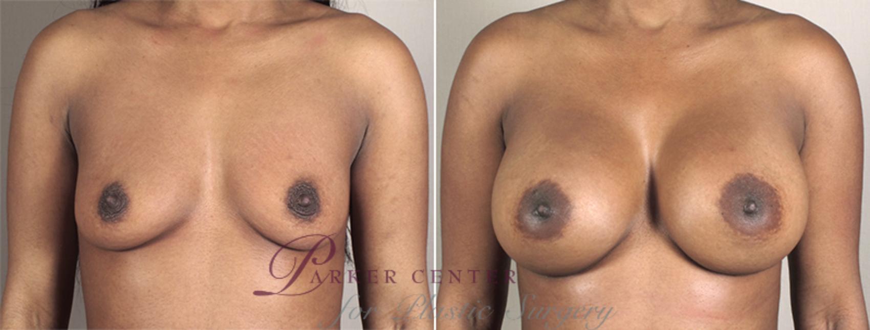 Breast Augmentation Case 399 Before & After View #1 | Paramus, NJ | Parker Center for Plastic Surgery