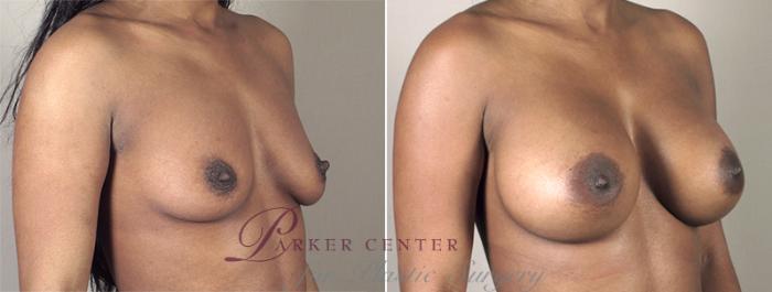 Breast Augmentation Case 399 Before & After View #2 | Paramus, NJ | Parker Center for Plastic Surgery