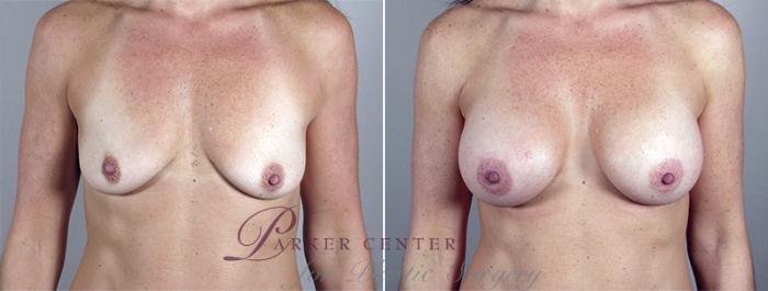 Breast Augmentation Case 400 Before & After View #1 | Paramus, NJ | Parker Center for Plastic Surgery