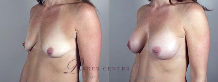 Breast Augmentation Case 400 Before & After View #2 | Paramus, NJ | Parker Center for Plastic Surgery