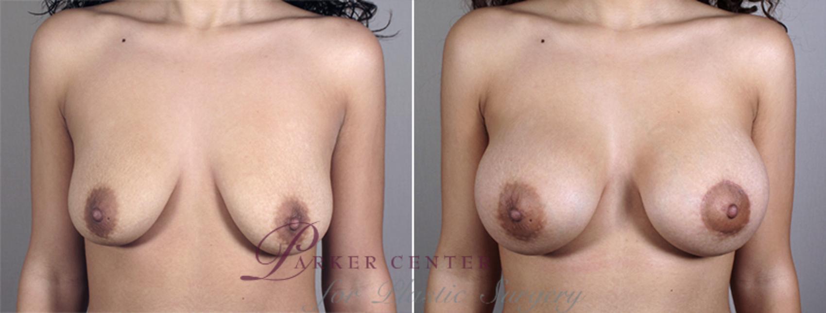 Breast Augmentation Case 401 Before & After View #1 | Paramus, NJ | Parker Center for Plastic Surgery