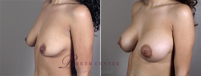 Breast Augmentation Case 401 Before & After View #2 | Paramus, NJ | Parker Center for Plastic Surgery