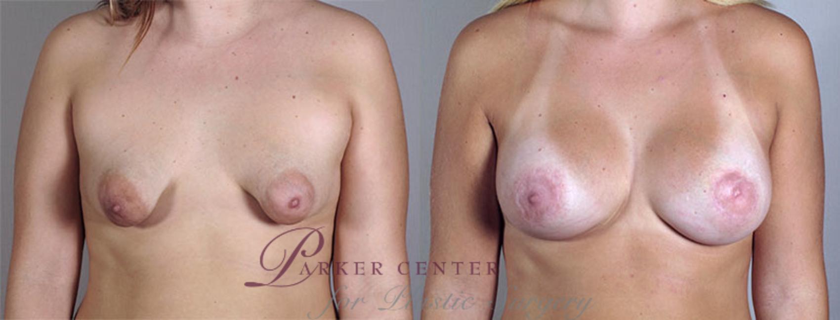 Breast Augmentation Case 402 Before & After View #1 | Paramus, NJ | Parker Center for Plastic Surgery