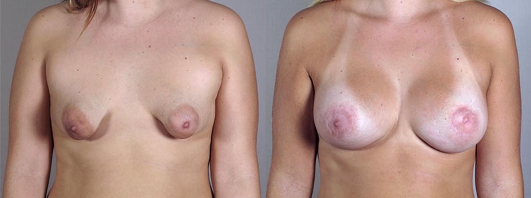 Correction of Tubular Breasts Case 402 Before & After View #1 | Paramus, NJ | Parker Center for Plastic Surgery