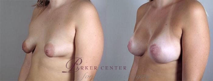 Breast Augmentation Case 402 Before & After View #2 | Paramus, NJ | Parker Center for Plastic Surgery