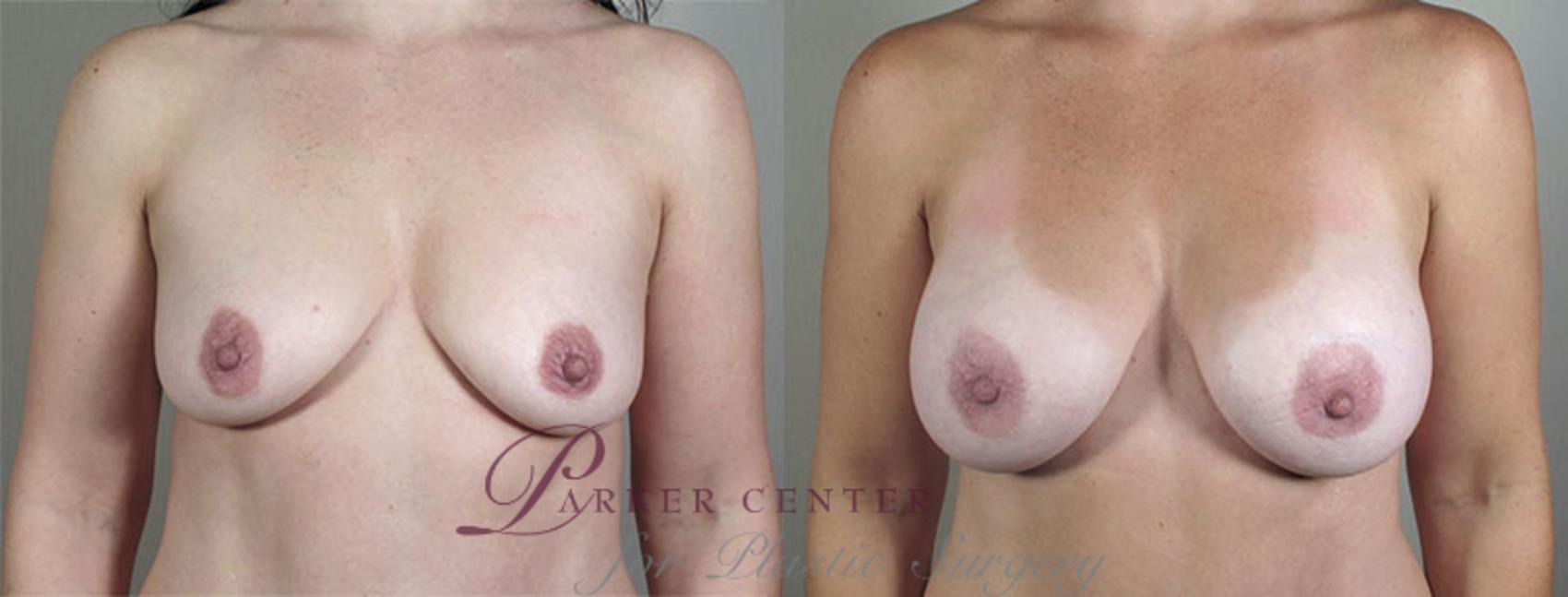 Breast Asymmetry Case 403 Before & After View #1 | Paramus, NJ | Parker Center for Plastic Surgery