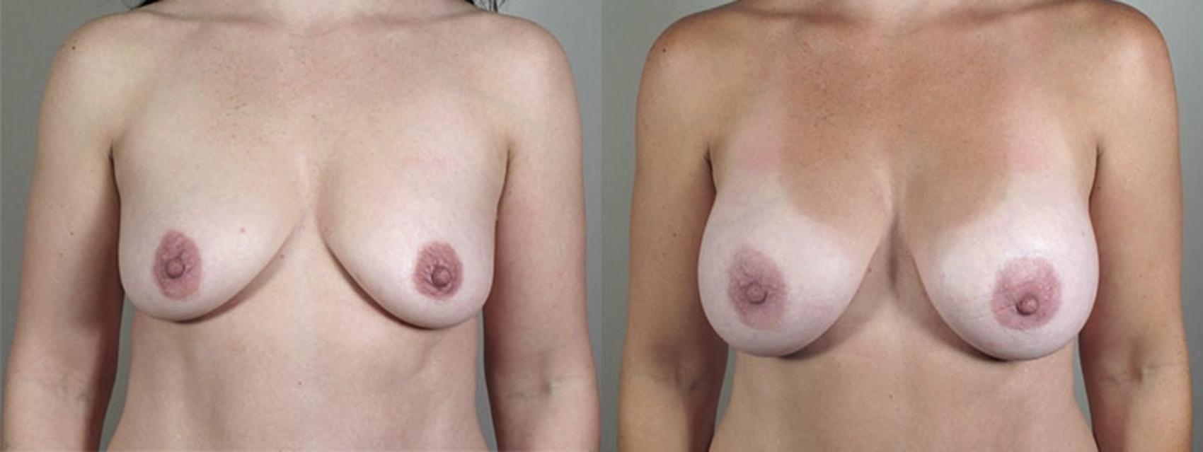 Breast Asymmetry Case 403 Before & After View #1 | Paramus, New Jersey | Parker Center for Plastic Surgery