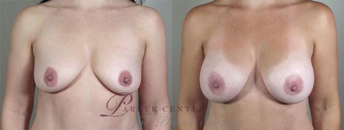 Breast Augmentation Case 403 Before & After View #1 | Paramus, NJ | Parker Center for Plastic Surgery