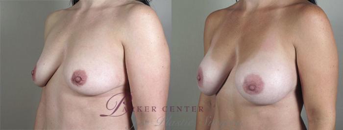 Breast Asymmetry Case 403 Before & After View #2 | Paramus, NJ | Parker Center for Plastic Surgery