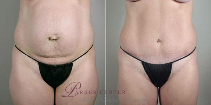 Breast Asymmetry Case 403 Before & After View #3 | Paramus, NJ | Parker Center for Plastic Surgery