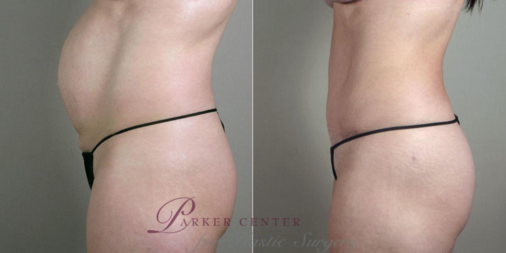 Breast Asymmetry Case 403 Before & After View #4 | Paramus, NJ | Parker Center for Plastic Surgery