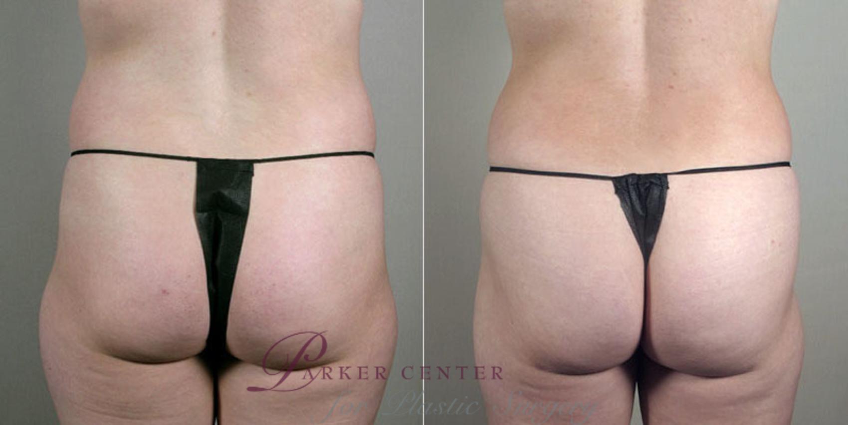 Breast Asymmetry Case 403 Before & After View #5 | Paramus, NJ | Parker Center for Plastic Surgery