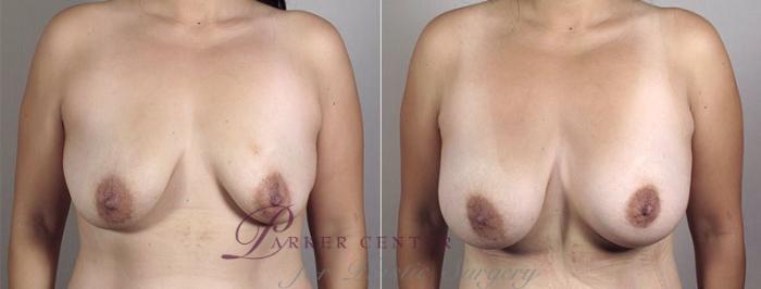 Breast Augmentation Case 404 Before & After View #1 | Paramus, NJ | Parker Center for Plastic Surgery