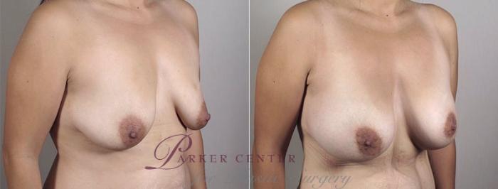 Breast Augmentation Case 404 Before & After View #2 | Paramus, NJ | Parker Center for Plastic Surgery