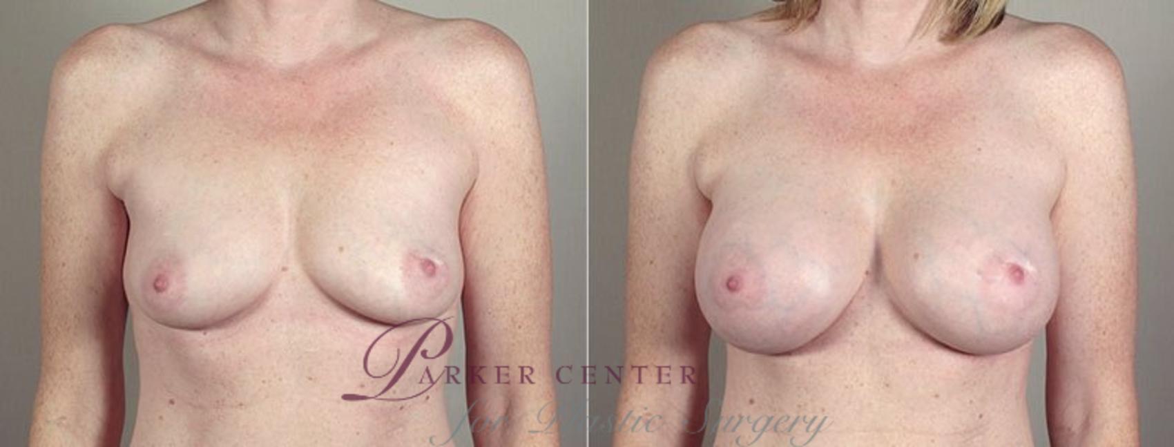 Breast Augmentation Case 405 Before & After View #1 | Paramus, NJ | Parker Center for Plastic Surgery