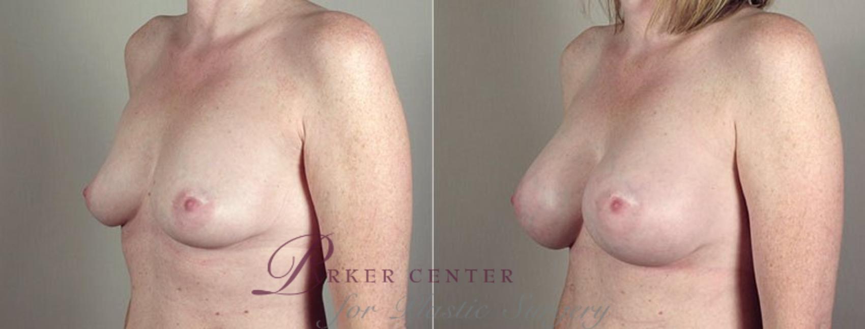 Breast Augmentation Case 405 Before & After View #2 | Paramus, NJ | Parker Center for Plastic Surgery