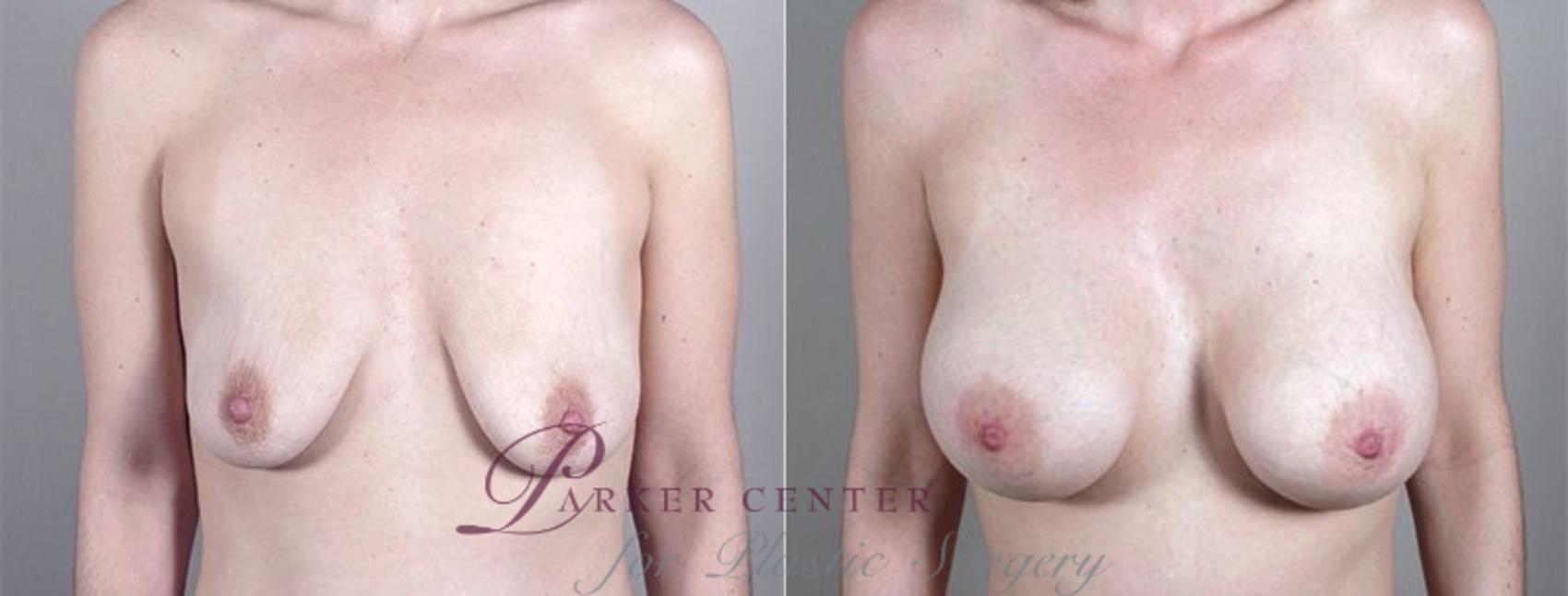 Breast Augmentation Case 409 Before & After View #1 | Paramus, NJ | Parker Center for Plastic Surgery