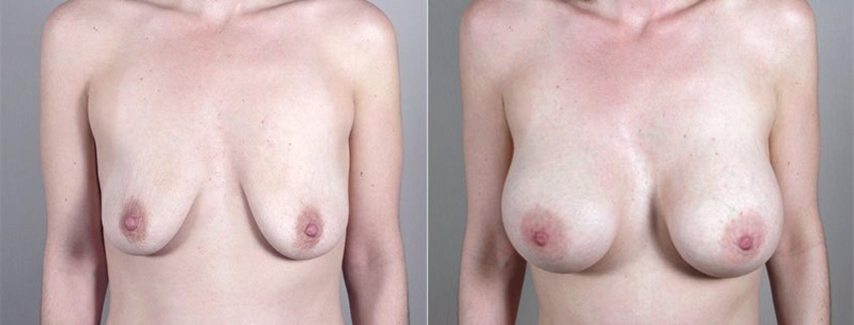 Breast Augmentation Case 409 Before & After View #1 | Paramus, New Jersey | Parker Center for Plastic Surgery