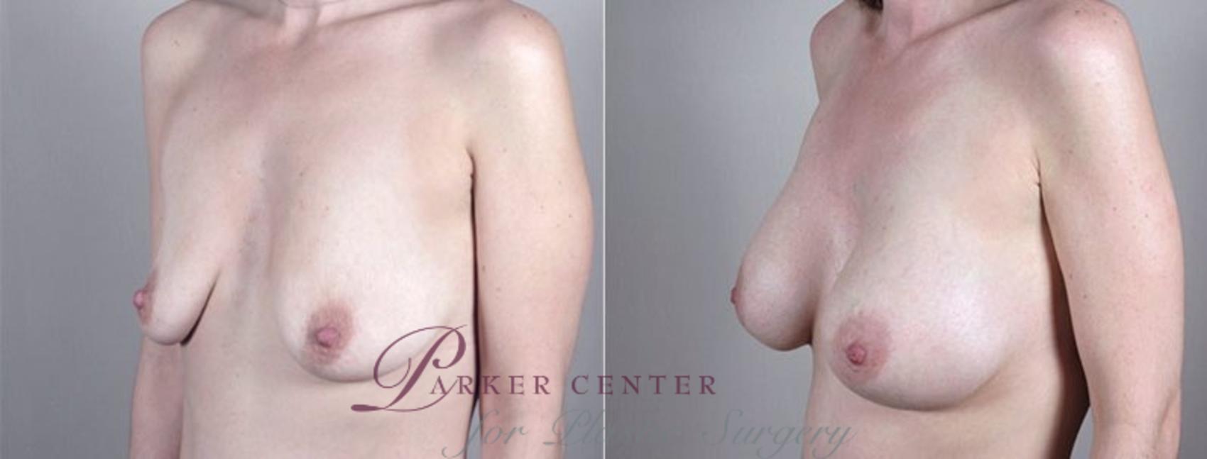 Breast Augmentation Case 409 Before & After View #2 | Paramus, NJ | Parker Center for Plastic Surgery