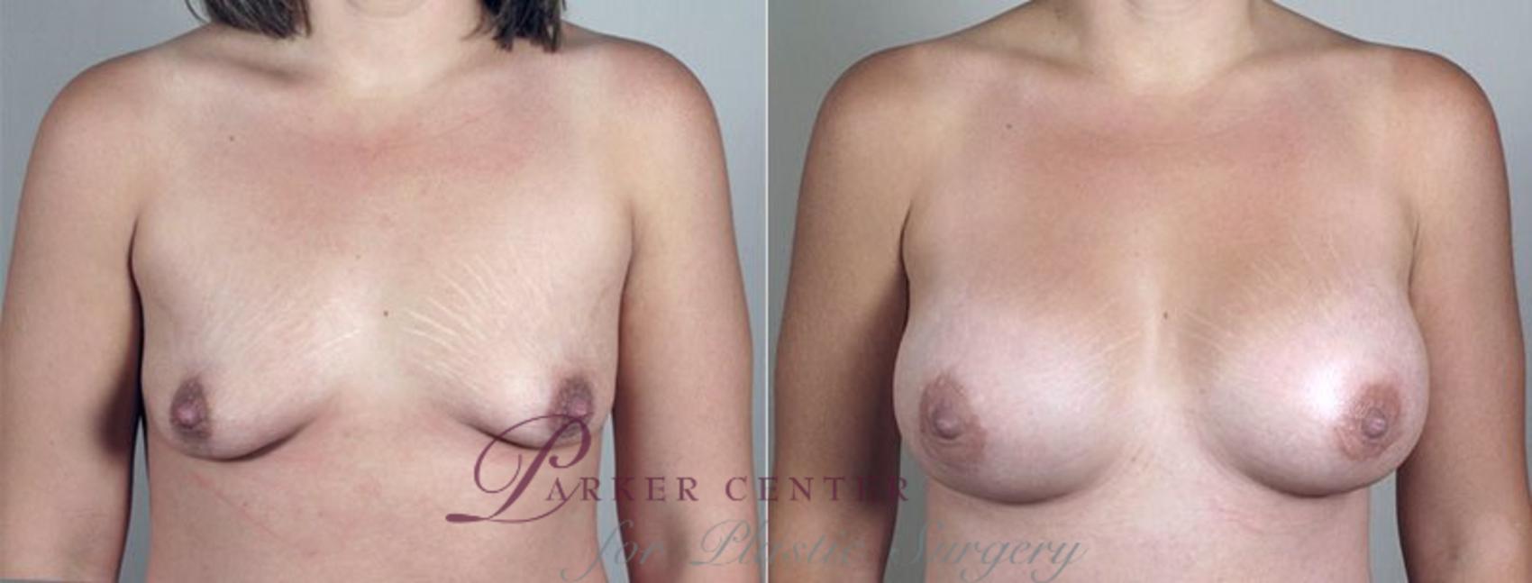 Breast Augmentation Case 410 Before & After View #1 | Paramus, NJ | Parker Center for Plastic Surgery