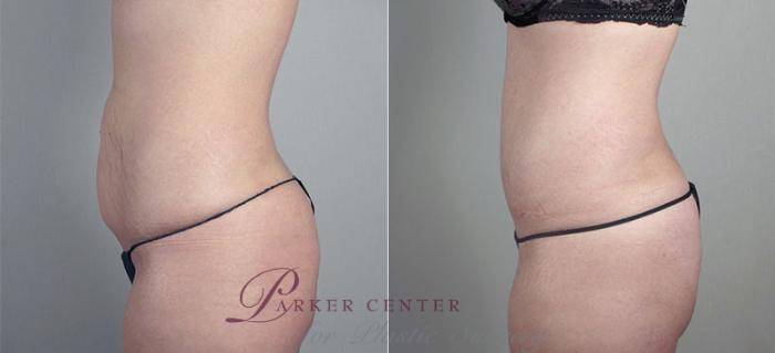 Mommy Makeover Case 410 Before & After View #4 | Paramus, NJ | Parker Center for Plastic Surgery