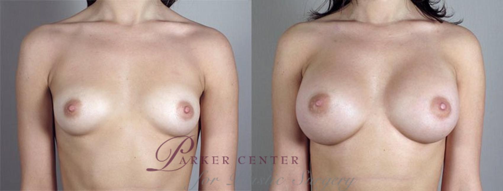 Breast Augmentation Case 411 Before & After View #1 | Paramus, NJ | Parker Center for Plastic Surgery