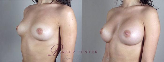 Breast Augmentation Case 411 Before & After View #2 | Paramus, NJ | Parker Center for Plastic Surgery