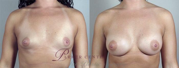 Breast Augmentation Case 412 Before & After View #1 | Paramus, NJ | Parker Center for Plastic Surgery