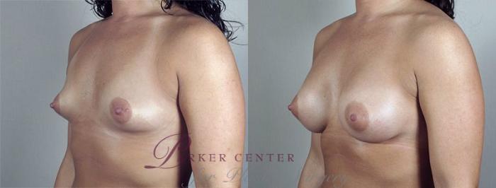 Breast Augmentation Case 412 Before & After View #2 | Paramus, NJ | Parker Center for Plastic Surgery