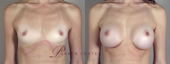 Breast Augmentation Case 413 Before & After View #1 | Paramus, NJ | Parker Center for Plastic Surgery