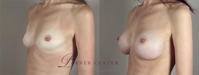 Breast Augmentation Case 413 Before & After View #2 | Paramus, NJ | Parker Center for Plastic Surgery