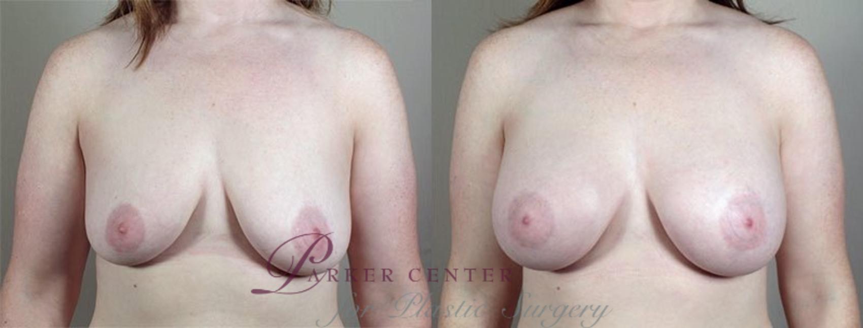 Breast Augmentation Case 414 Before & After View #1 | Paramus, NJ | Parker Center for Plastic Surgery
