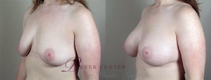 Breast Augmentation Case 414 Before & After View #2 | Paramus, NJ | Parker Center for Plastic Surgery