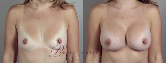 Breast Augmentation Case 415 Before & After View #1 | Paramus, NJ | Parker Center for Plastic Surgery