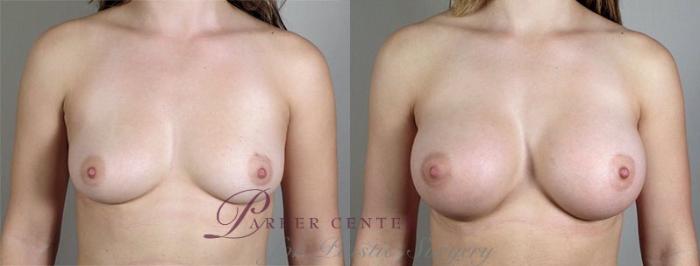 Breast Augmentation Case 416 Before & After View #1 | Paramus, NJ | Parker Center for Plastic Surgery
