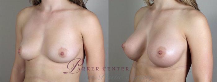 Breast Augmentation Case 416 Before & After View #2 | Paramus, NJ | Parker Center for Plastic Surgery