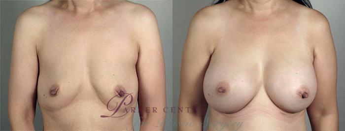 Breast Augmentation Case 417 Before & After View #1 | Paramus, NJ | Parker Center for Plastic Surgery
