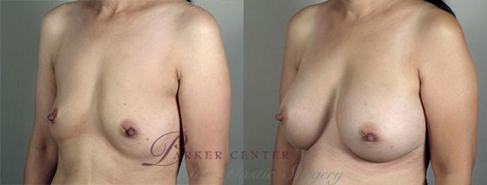 Breast Augmentation Case 417 Before & After View #2 | Paramus, NJ | Parker Center for Plastic Surgery