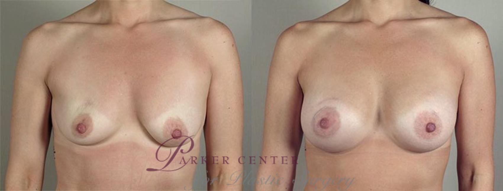 Breast Augmentation Case 418 Before & After View #1 | Paramus, NJ | Parker Center for Plastic Surgery