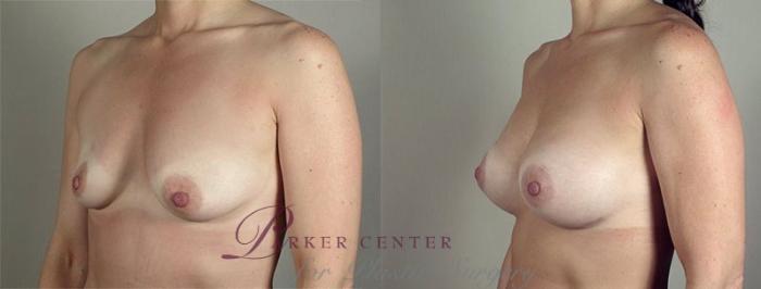 Breast Augmentation Case 418 Before & After View #2 | Paramus, NJ | Parker Center for Plastic Surgery
