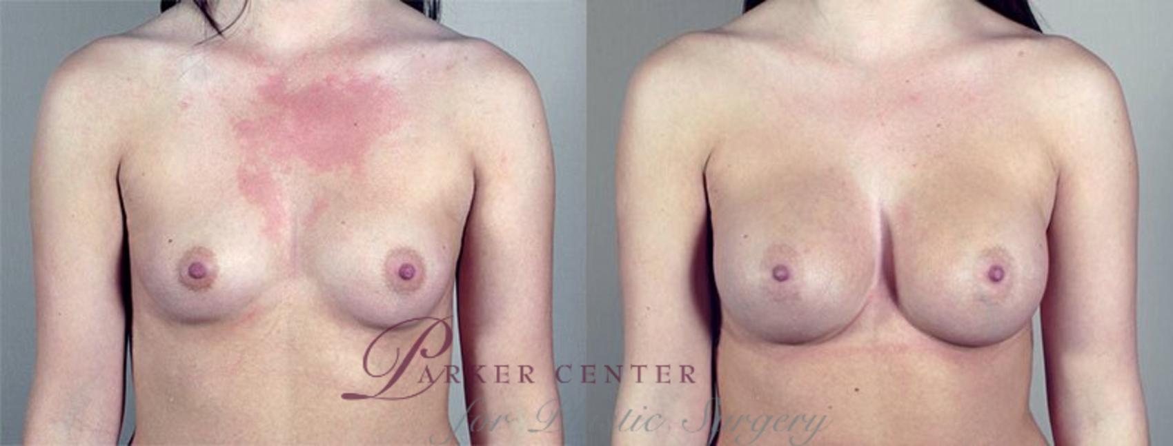 Breast Augmentation Case 419 Before & After View #1 | Paramus, NJ | Parker Center for Plastic Surgery