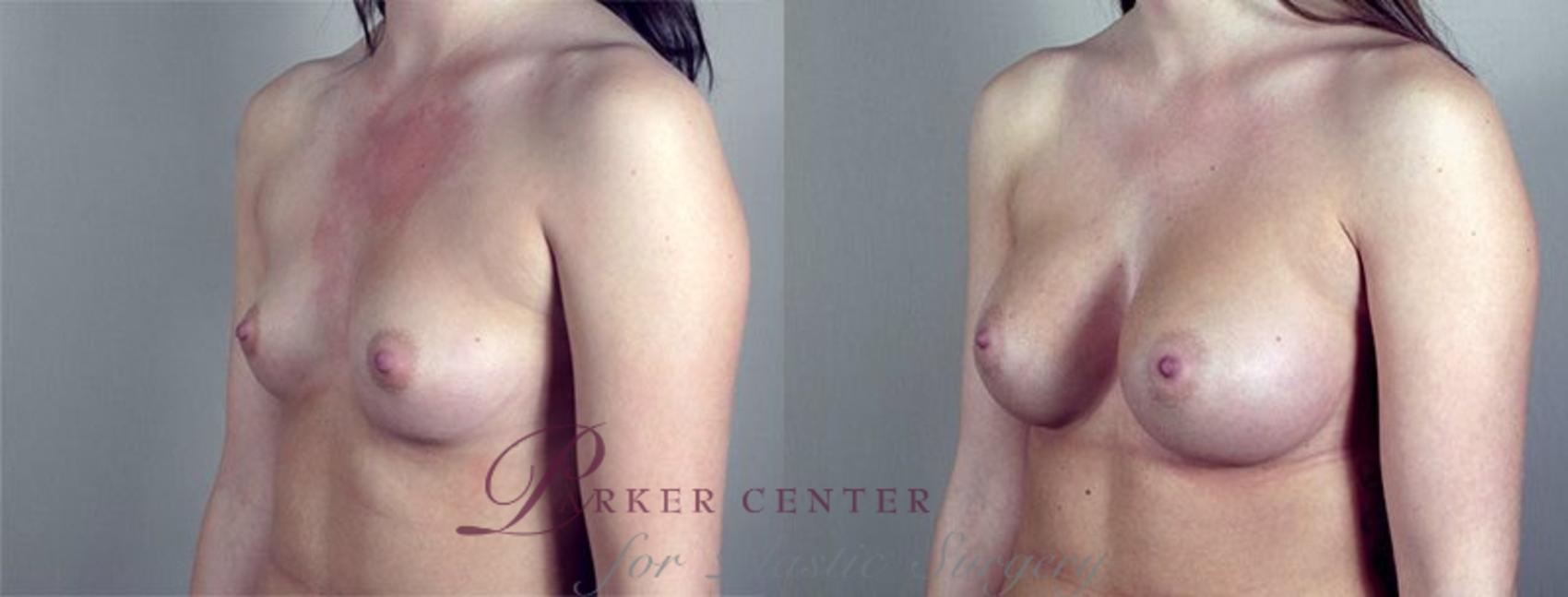 Breast Augmentation Case 419 Before & After View #2 | Paramus, New Jersey | Parker Center for Plastic Surgery