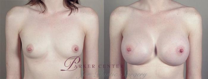 Breast Augmentation Case 420 Before & After View #1 | Paramus, NJ | Parker Center for Plastic Surgery